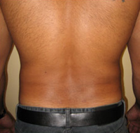 Liposuction Recovery