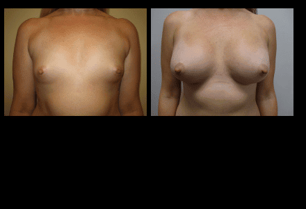 Breast Augmentation Before and After Patient 1