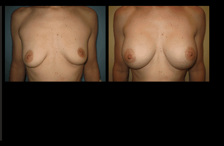 Breast Augmentation Before and After Patient 10