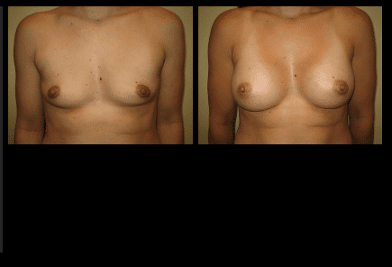 Breast Augmentation Before and After Patient 11