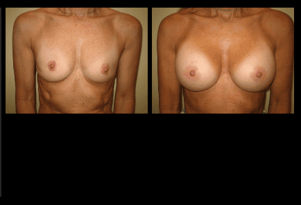 Breast Augmentation Before and After Patient 12