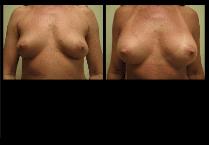 Breast Augmentation Before and After Patient 14