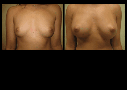 Breast Augmentation Before and After Patient 15