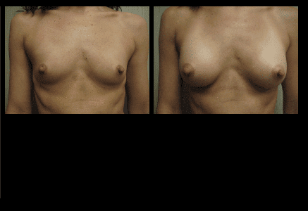 Breast Augmentation Before and After Patient 16