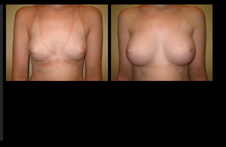 Breast Augmentation Before and After Patient 17