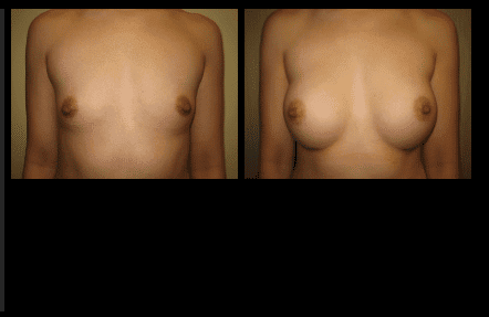 Breast Augmentation Before and After Patient 18