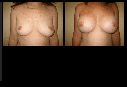 Breast Augmentation Before and After Patient 19