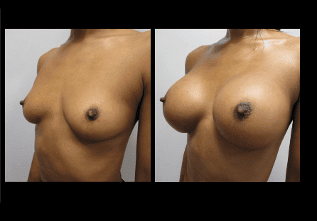 Breast Augmentation Before and After Patient 2