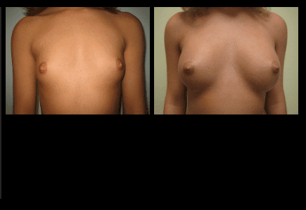 Breast Augmentation Before and After Patient 20