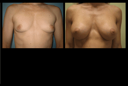 Breast Augmentation Before and After Patient 23