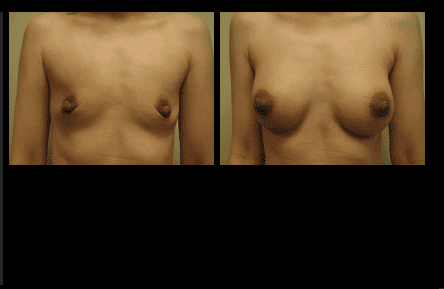 Breast Augmentation Before and After Patient 24