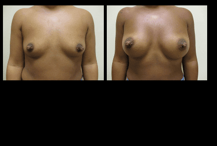 Breast Augmentation Before and After Patient 3