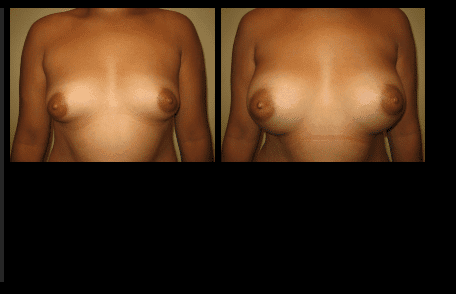 Breast Augmentation Before and After Patient 30