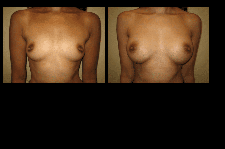 Breast Augmentation Before and After Patient 31