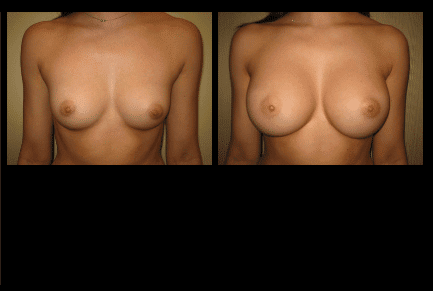 Breast Augmentation Before and After Patient 32