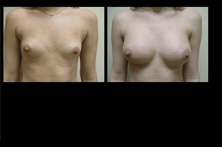 Breast Augmentation Before and After Patient 4