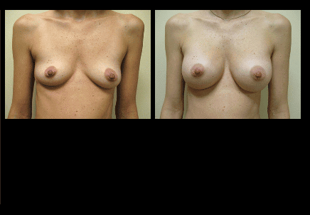 Breast Augmentation Before and After Patient 8