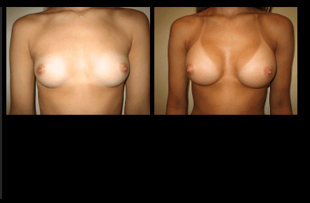 Breast Augmentation Before and After Patient 6