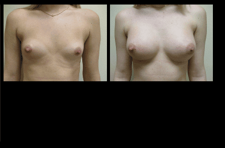 Breast Augmentation Before and After Patient 7