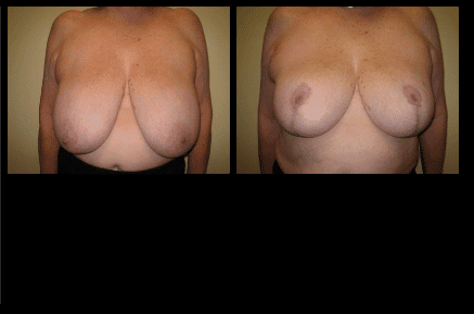 Breast Reduction Before and After Patient 2