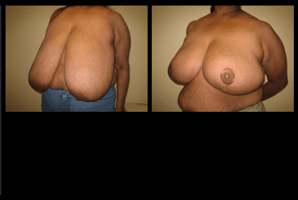 Breast Reduction Before and After Patient 4