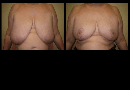 Breast Reduction Before and After Patient 5