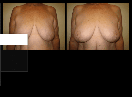 Breast Reduction Before and After Patient 6