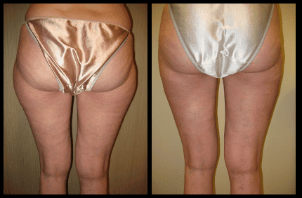 Butt Liposuction Before and After Patient 13