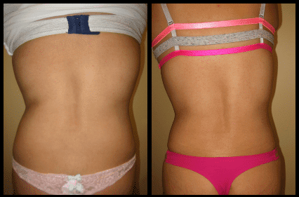 Love Handle Liposuction Before and After Patient 15