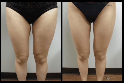 Thigh Liposuction Before and After Patient 1