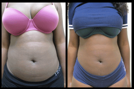 Stomach Liposuction Before and After Patient 11