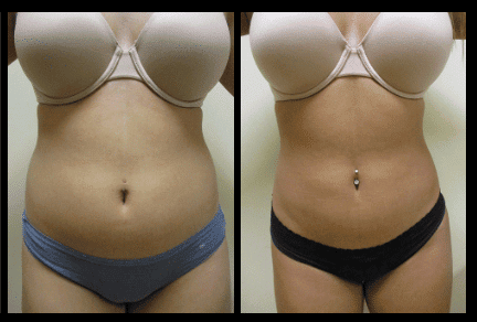 Stomach Liposuction Before and After Patient 12