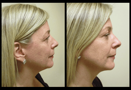 Chin Liposuction Before and After Patient 14