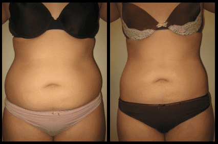 Stomach Liposuction Before and After Patient 17