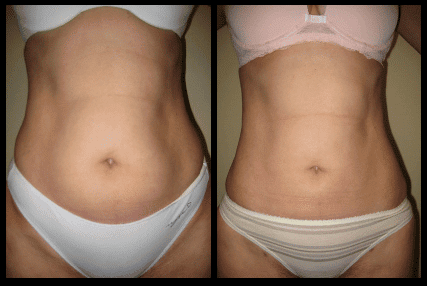 Abdomen Liposuction Before and After Patient 18