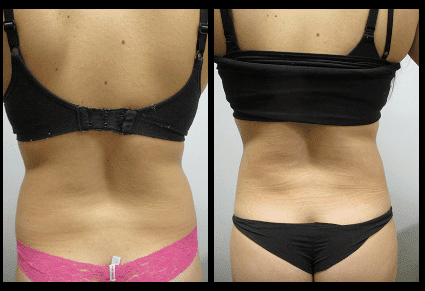 Back Liposuction Before and After Patient 2