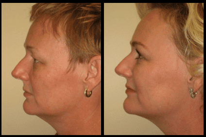 Chin Liposuction Before and After Patient 20