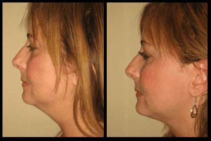 Chin Liposuction Before and After Patient 21