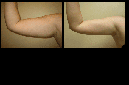 Arm Liposuction Before and After Patient 22