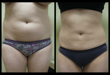 Abdomen Liposuction Before and After Patient 23