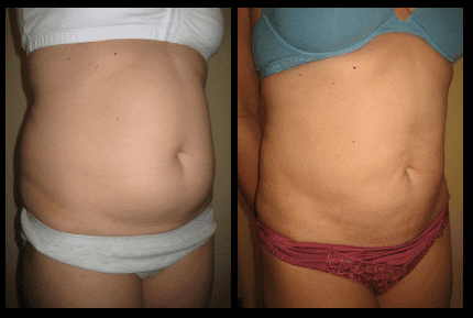 Stomach Liposuction Before and After Patient 24