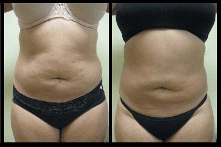 Abdomen Liposuction Before and After Patient 26