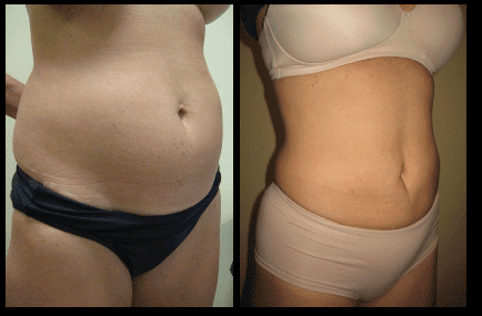 Abdomen Liposuction Before and After Patient 27