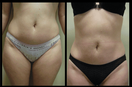 Stomach Liposuction Before and After Patient 29