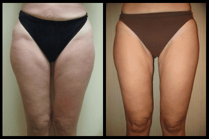 Hip Liposuction Before and After Patient 3