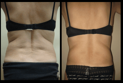 Back Liposuction Before and After Patient 30