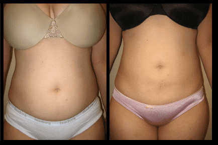 Ab Liposuction Before and After Patient 31