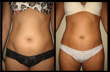 Stomach Liposuction Before and After Patient 32