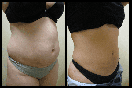 Hip Liposuction Before and After Patient 34