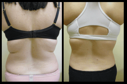 Back Liposuction Before and After Patient 6